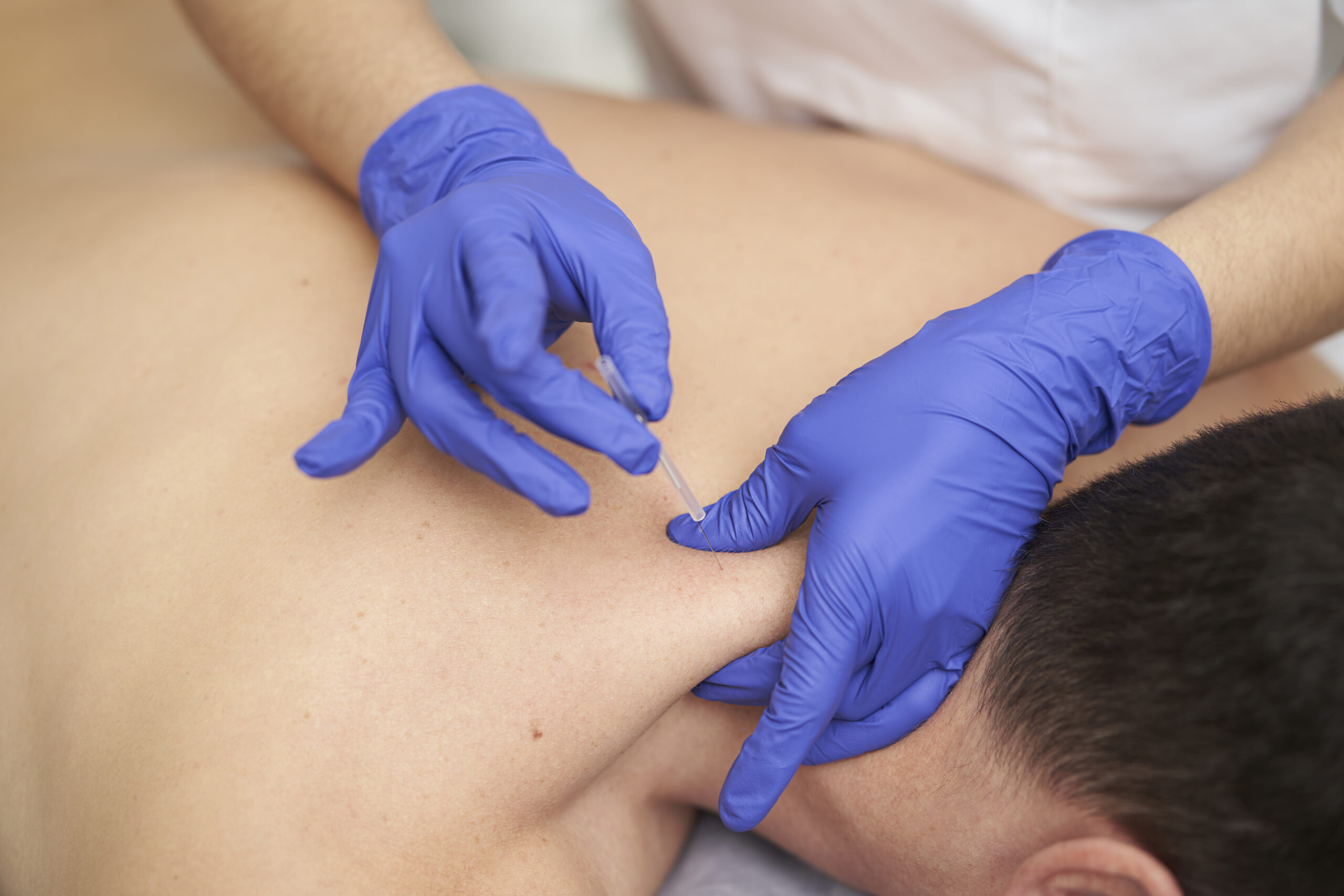 Physiotherapist treating a patient with dry needling.